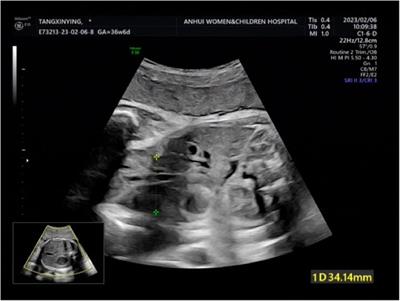 Case Report: foetal gastroschisis with ideal pregnancy outcomes under multidisciplinary treatment management